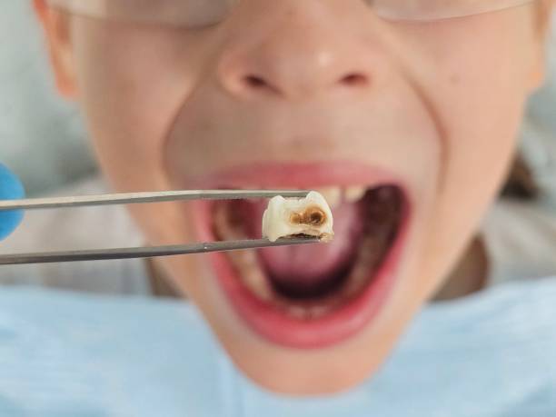 Best Emergency Dentist for Knocked-Out Tooth in South Hempstead, NY